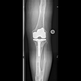 Röntgenaufnahme eines Kniegelenks mit implantierter Knieendoprothese in Frontalansicht.