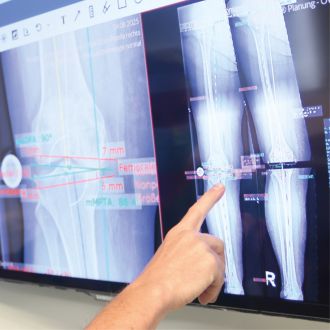 Hand zeigt auf eine digitale Röntgen- und Planungsdarstellung eines Kniegelenks auf einem Monitor.