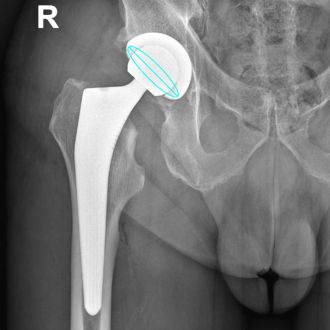 Röntgenbild einer Hüftprothese.
