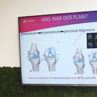Grafische Darstellung der präoperativen Planung bei Knieendoprothesen mit Rekonstruktion der Beinachse.