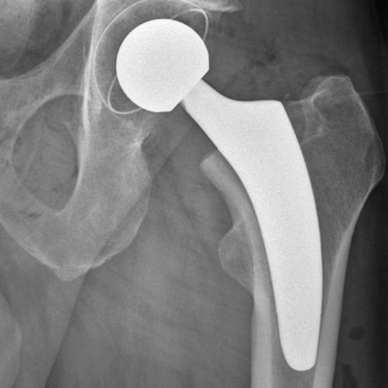 Röntgenaufnahme eines Hüftgelenks mit eingesetzter Hüftprothese.