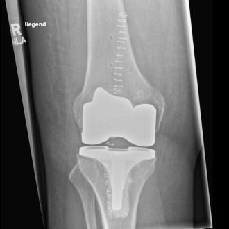 Röntgenbild einer Knievollprothese.
