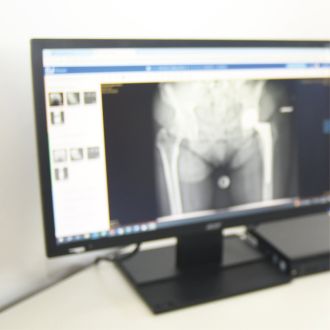 Monitor mit Röntgenaufnahme des Beckens und der Hüftgelenke in einer medizinischen Bildanzeige.