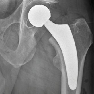 Röntgenaufnahme eines Hüftgelenks mit eingesetzter Hüftprothese.