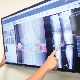 Hand zeigt auf eine digitale Röntgen- und Planungsdarstellung eines Kniegelenks auf einem Monitor.