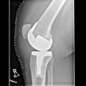 Seitliche Röntgenaufnahme eines Kniegelenks mit eingesetzter Knieendoprothese.