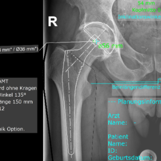 Röntgenbild Hüftendoprothetik.