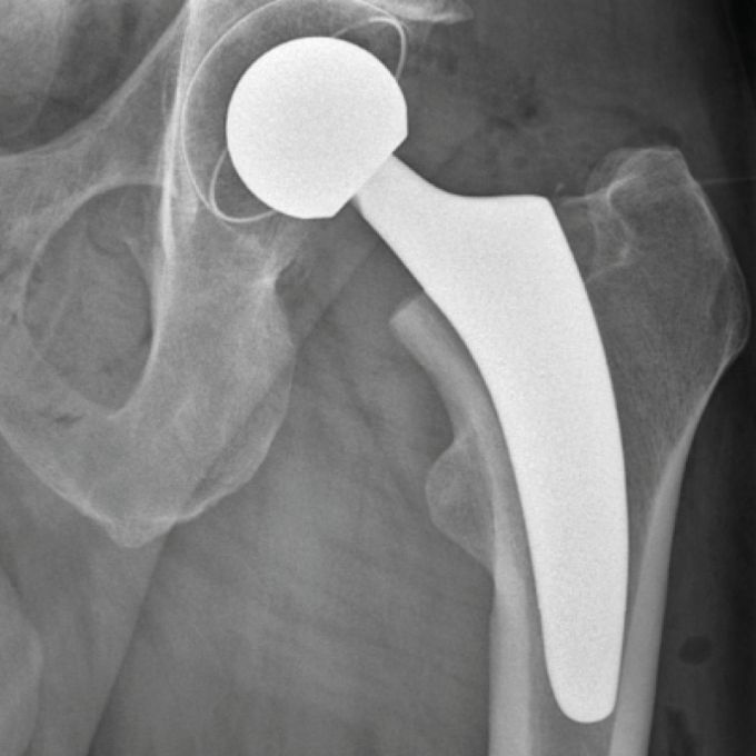 Röntgenaufnahme eines Hüftgelenks mit eingesetzter Hüftprothese.